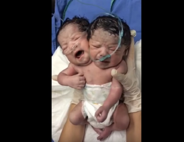 В Мексике родился младенец с 2-мя головами