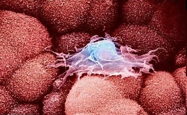 Ученые узнали, как распространяются клетки рака