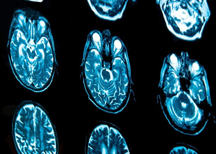 Ученые Предрасположенность к наркотикам можно узнать по снимку мозга