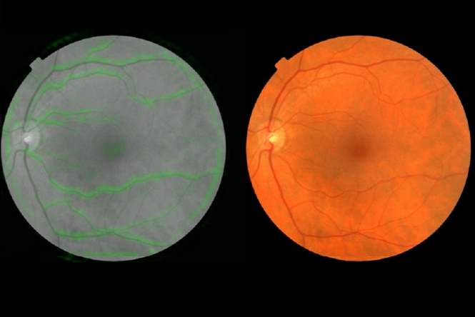 AI-алгоритм Google предсказывает риск сердечно-сосудистых заболеваний по сетчатке глаз