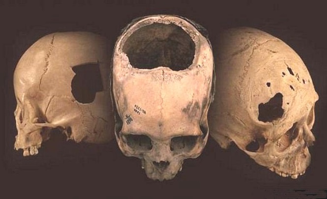 Профессиональная трепанация черепа выполнялась еще древними инками