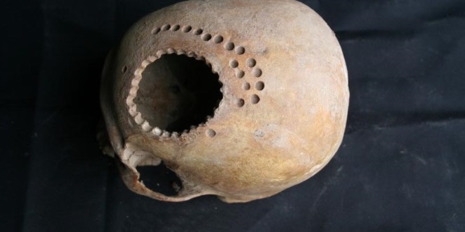 Профессиональная трепанация черепа выполнялась еще древними инками