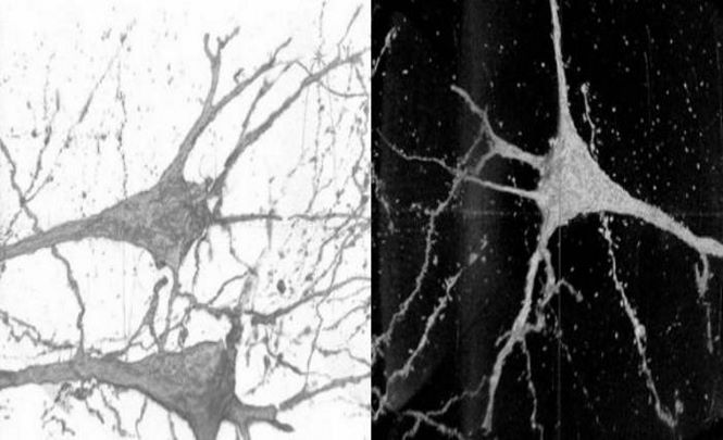 В мозгу людей с шизофренией заметили необычные нейроны