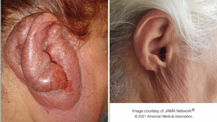 Зловонное женское `` индюшачье ухо '' вызвано многолетней инфекцией