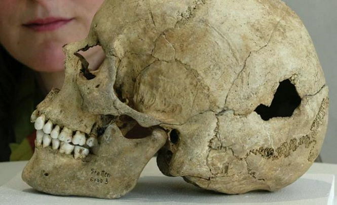 Зачем наши предки сверлили дырки в черепах 