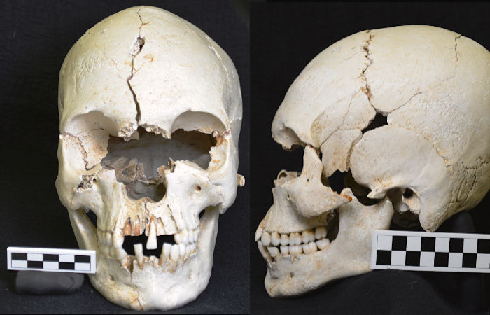 Редкий древний карибский череп свидетельствует о проказе