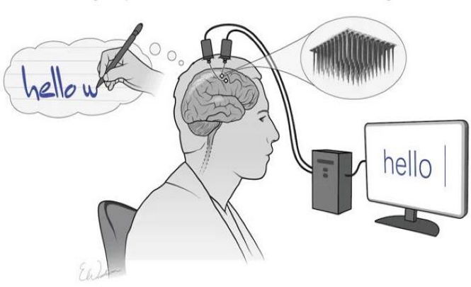 Мозговой имплант перевел мысли парализованного человека