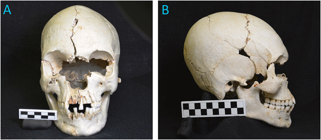 Древний карибский череп свидетельствует о проказе