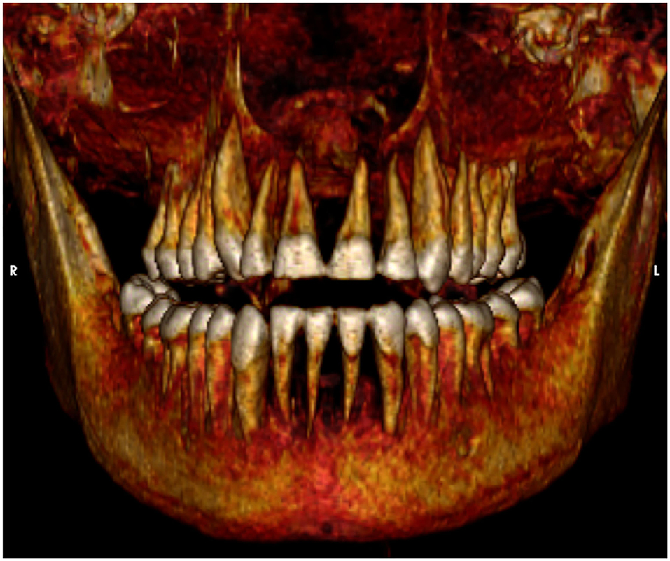На этом изображении показаны здоровые зубы Аменхотепа I. Кредит: Сахар Салим и Захи Хавасс / Frontiers in Medicine, 2021 г.