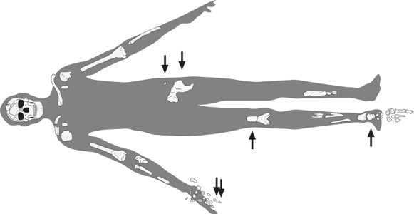 Найдены части скелета Омо I. Стрелками указаны кости, добытые при раскопках 1999–2003 гг. Кредит: Журнал эволюции человека. 2008. Т. 55. С. 421–437.