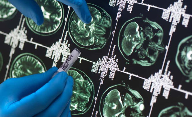 Появляются новые пугающие подробности о загадочном заболевании мозга в Канаде