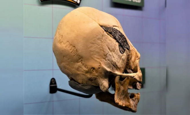 Древняя операция на черепе с металлической пластиной