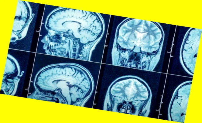 Исследователь обнаружил странное повреждение мозга у людей, ставших свидетелями НЛО