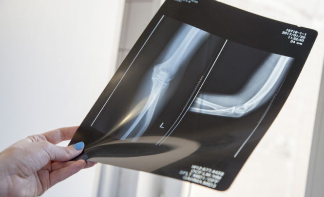 Ученые изучили разрушительное воздействие рентгена на кости